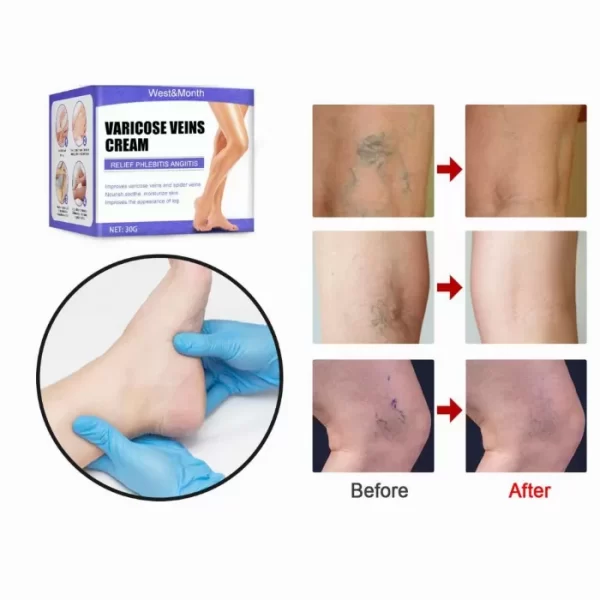 Veins Cream крем за разширени вени и профилактика